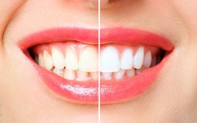 Teeth-Whitening-Washington Pa